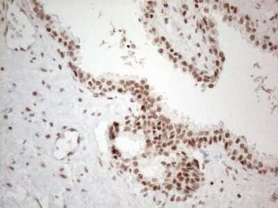 Immunohistochemistry: TR4/NR2C2 Antibody (4B1) [NBP2-46228] - Analysis of Carcinoma of Human prostate tissue. (Heat-induced epitope retrieval by 1mM EDTA in 10mM Tris buffer (pH8.5) at 120C for 3 min)