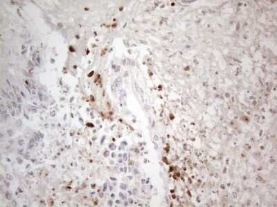 Immunohistochemistry: TR4/NR2C2 Antibody (OTI4B1) - Azide and BSA Free [NBP2-74577] - Analysis of Adenocarcinoma of Human colon tissue. (Heat-induced epitope retrieval by 1mM EDTA in 10mM Tris buffer (pH8.5) at 120C for 3 min)