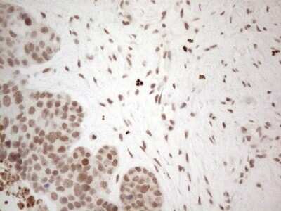 Immunohistochemistry: TR4/NR2C2 Antibody (OTI4B1) - Azide and BSA Free [NBP2-74577] - Analysis of Adenocarcinoma of Human endometrium tissue. (Heat-induced epitope retrieval by 1mM EDTA in 10mM Tris buffer (pH8.5) at 120C for 3 min)