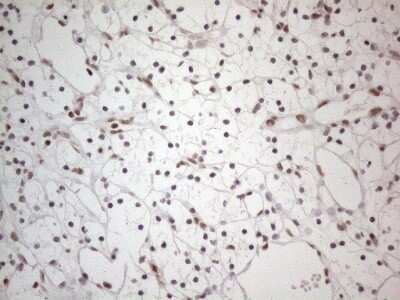 Immunohistochemistry: TR4/NR2C2 Antibody (OTI4B1) - Azide and BSA Free [NBP2-74577] - Analysis of Carcinoma of Human kidney tissue. (Heat-induced epitope retrieval by 1mM EDTA in 10mM Tris buffer (pH8.5) at 120C for 3 min)