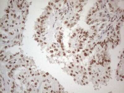 Immunohistochemistry: TR4/NR2C2 Antibody (OTI4B1) - Azide and BSA Free [NBP2-74577] - Analysis of Carcinoma of Human thyroid tissue. (Heat-induced epitope retrieval by 1mM EDTA in 10mM Tris buffer (pH8.5) at 120C for 3 min)