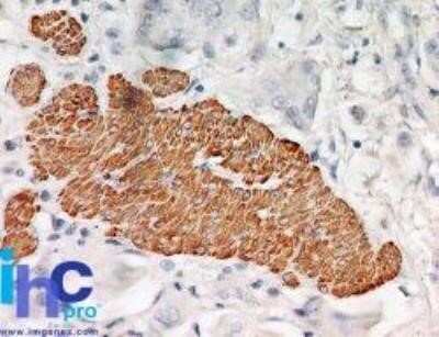 Immunocytochemistry: TRAF-2 Antibody (33A1293) - Azide and BSA Free [NBP2-80987] - Human transitional cell carcinoma of the urinary bladder stained with TRAF2 antibody at 5 ug/ml. Staining of formalin-fixed tissues is enhanced by boiling tissue sections in 10 mM sodium citrate buffer, pH 6.0 for 10-20 min followed by cooling at RT for 2