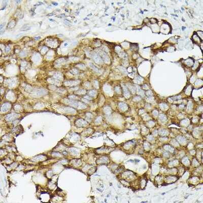 Immunohistochemistry-Paraffin: TRAF7 Antibody [NBP3-04330] - Immunohistochemistry of paraffin-embedded human colon carcinoma using TRAF7 antibody (NBP3-04330) at dilution of 1:50 (40x lens). Perform high pressure antigen retrieval with 10 mM citrate buffer pH 6.0 before commencing with IHC staining protocol.