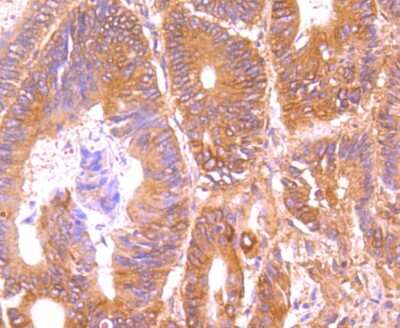 Immunohistochemistry-Paraffin: TRAILR2/TNFRSF10B Antibody (JA03-38) [NBP2-67225] - Analysis of paraffin-embedded human colon cancer tissue using anti-DR5 antibody. Counter stained with hematoxylin.