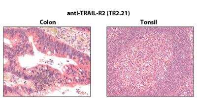 Immunohistochemistry-Paraffin: TRAILR2/TNFRSF10B Antibody (TR2.21) [NBP2-80070] - Immunohistochemistry detection of endogenous TRAIL-R2 in paraffin-embedded human carcinoma tissues (colon, tonsil) using mAb to TRAIL-R2 (TR2.21).