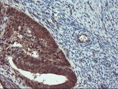 Immunohistochemistry: TRAIP Antibody (OTI2D4) - Azide and BSA Free [NBP2-74580] - Staining of paraffin-embedded Adenocarcinoma of Human endometrium tissue using anti-TRAIP mouse monoclonal antibody.