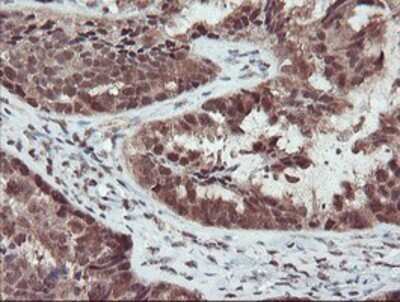 Immunohistochemistry: TRAIP Antibody (OTI2D4) - Azide and BSA Free [NBP2-74580] - Staining of paraffin-embedded Adenocarcinoma of Human ovary tissue using anti-TRAIP mouse monoclonal antibody.