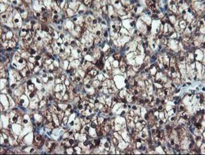 Immunohistochemistry: TRAIP Antibody (OTI2D4) - Azide and BSA Free [NBP2-74580] - Staining of paraffin-embedded Carcinoma of Human kidney tissue using anti-TRAIP mouse monoclonal antibody.