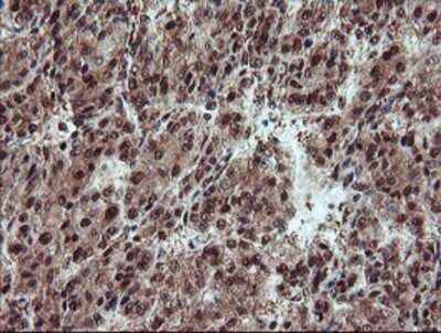 Immunohistochemistry: TRAIP Antibody (OTI2D4) - Azide and BSA Free [NBP2-74580] - Staining of paraffin-embedded Carcinoma of Human liver tissue using anti-TRAIP mouse monoclonal antibody.