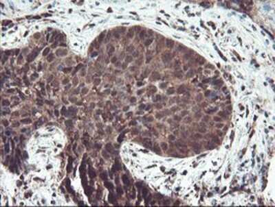 Immunohistochemistry: TRAIP Antibody (OTI2D4) - Azide and BSA Free [NBP2-74580] - Staining of paraffin-embedded Carcinoma of Human lung tissue using anti-TRAIP mouse monoclonal antibody.