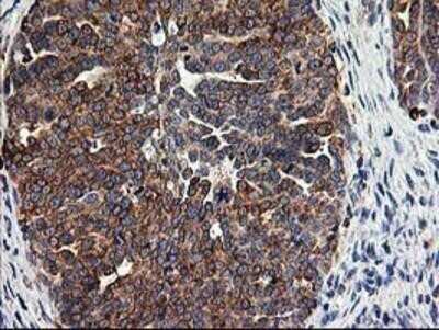 Immunohistochemistry: TRAP alpha Antibody (OTI4C7) - Azide and BSA Free [NBP2-74591] - Staining of paraffin-embedded Adenocarcinoma of Human ovary tissue using anti-TRAP alpha mouse monoclonal antibody.