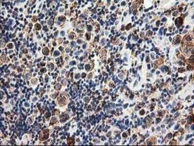 Immunohistochemistry: TRAP alpha Antibody (OTI4C7) - Azide and BSA Free [NBP2-74591] - Staining of paraffin-embedded Carcinoma of Human lung tissue using anti-TRAP alpha mouse monoclonal antibody.