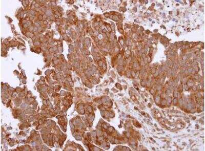 Immunohistochemistry-Paraffin: TRAP1 Antibody [NBP2-20700] - Ovarian carcinoma. TRAP1 antibody [N1N3] dilution: 1:250. Antigen Retrieval: Trilogy™ (EDTA based, pH 8.0) buffer, 15min.