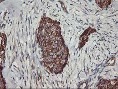 Immunohistochemistry: TRAP1 Antibody (OTI1H8) - Azide and BSA Free [NBP2-74592] - Staining of paraffin-embedded Adenocarcinoma of Human breast tissue using anti-TRAP1 mouse monoclonal antibody.