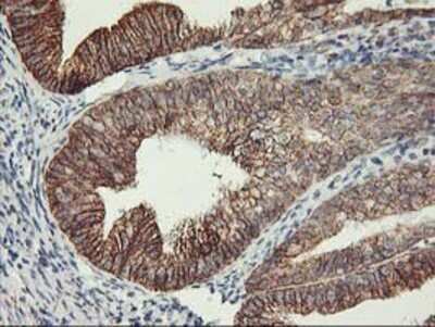 Immunohistochemistry: TRAP1 Antibody (OTI1H8) - Azide and BSA Free [NBP2-74592] - Staining of paraffin-embedded Adenocarcinoma of Human endometrium tissue using anti-TRAP1 mouse monoclonal antibody.