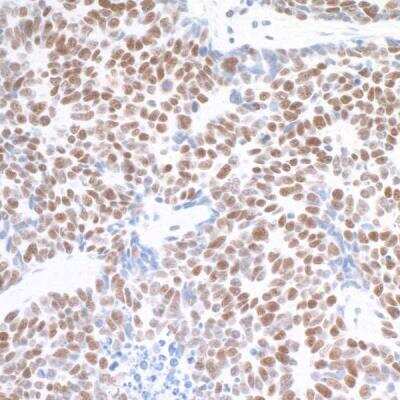 Immunohistochemistry: TRAP220/MED1 Antibody (BLR037F) [NBP2-76407] - Detection of human MED1 in FFPE small cell lung cancer by IHC. Antibody: Rabbit anti-MED1 recombinant monoclonal [BLR037F] (NBP2-76407). Secondary: HRP-conjugated goat anti-rabbit IgG. Substrate: DAB.