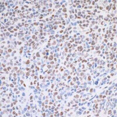 Immunohistochemistry: TRAP220/MED1 Antibody (BLR037F) [NBP2-76407] - Detection of mouse MED1 in FFPE mouse renal cell carcinoma by IHC. Antibody: Rabbit anti-MED1 recombinant monoclonal [BLR037F] (NBP2-76407). Secondary: HRP-conjugated goat anti-rabbit IgG. Substrate: DAB.