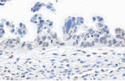 Immunohistochemistry-Paraffin: TRAP220/MED1 Antibody [NB100-2574] - Section of human ovarian carcinoma. Antibody: Affinity purified rabbit anti-MED1 antibody  used at 1:5000 (0.2ug/ml). Secondary: HRP-conjugated goat anti-rabbit IgG