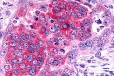 Immunohistochemistry-Paraffin: TRAR4 Antibody [NLS2312] - Anti-TAAR6 antibody IHC of human Ovary, Carcinoma. Immunohistochemistry of formalin-fixed, paraffin-embedded tissue after heat-induced antigen retrieval.