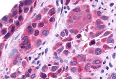 Immunohistochemistry-Paraffin: TRAR4 Antibody [NLS2312] - Anti-TAAR6 antibody IHC of human Skin, Melanoma. Immunohistochemistry of formalin-fixed, paraffin-embedded tissue after heat-induced antigen retrieval.
