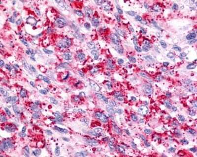 Immunohistochemistry-Paraffin: TRAR4 Antibody [NLS2313] - Analysis of anti-TAAR6 antibody with human brain, glioblastoma.