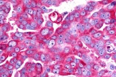 Immunohistochemistry-Paraffin: TRAR4 Antibody [NLS2313] - Anti-TAAR6 antibody IHC of human Ovary, Carcinoma. Immunohistochemistry of formalin-fixed, paraffin-embedded tissue after heat-induced antigen retrieval.