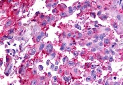 Immunohistochemistry-Paraffin: TRAR4 Antibody [NLS2313] - Anti-TAAR6 antibody IHC of human Skin, Melanoma. Immunohistochemistry of formalin-fixed, paraffin-embedded tissue after heat-induced antigen retrieval.