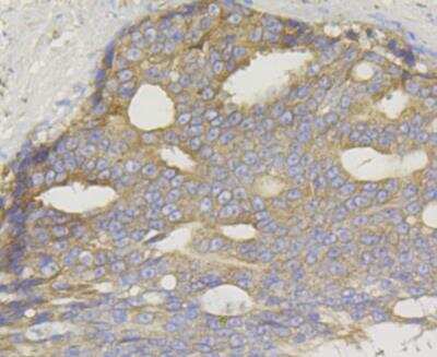 Immunohistochemistry: TREX1 Antibody (JG35-71) [NBP2-76875] - Immunohistochemical analysis of paraffin-embedded human prostate cancer tissue using anti-TREX1 antibody. Counter stained with hematoxylin.