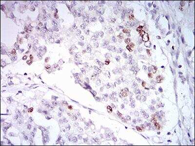 Immunohistochemistry-Paraffin: TRF-2 Antibody (3H6B4) [NBP2-26298] - Analysis of paraffin embedded human ovarian cancer tissue.
