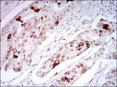 Immunohistochemistry-Paraffin: TRF-2 Antibody (3H6B4) [NBP2-26298] - Analysis of paraffin embedded rectum cancer tissue.