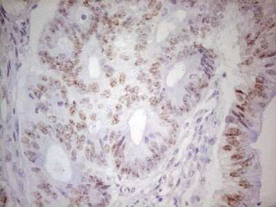 Immunohistochemistry: TRIB1 Antibody (8C8) [NBP2-46205] - Analysis of Adenocarcinoma of Human colon tissue. (Heat-induced epitope retrieval by 1 mM EDTA in 10mM Tris, pH8.5, 120C for 3min)