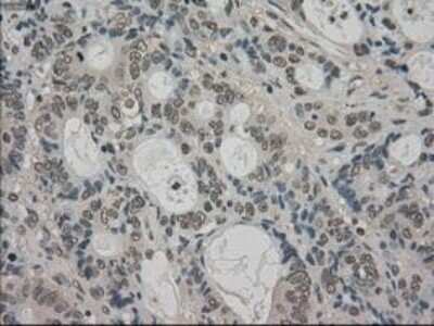 Immunohistochemistry-Paraffin: TRIB2 Antibody (OTI8D11) [NBP1-48030] - Staining of paraffin-embedded Adenocarcinoma of Human colon tissue using anti-TRIB2 mouse monoclonal antibody.