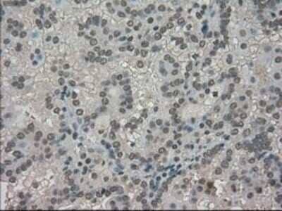 Immunohistochemistry-Paraffin: TRIB2 Antibody (OTI8D11) [NBP1-48030] - Staining of paraffin-embedded Adenocarcinoma of Human ovary tissue using anti-TRIB2 mouse monoclonal antibody.