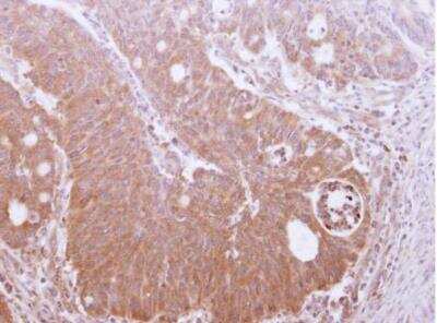 Immunohistochemistry-Paraffin: TRIM17 Antibody [NBP2-20708] -  Paraffin-embedded human colon carcinoma. TRIM17 antibody [N1N3] dilution: 1:250.