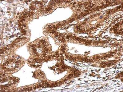 Immunohistochemistry-Paraffin: TRIM27 Antibody [NBP2-20712] - Immunohistochemical analysis of paraffin-embedded Colon ca, using antibody at 1:500 dilution.