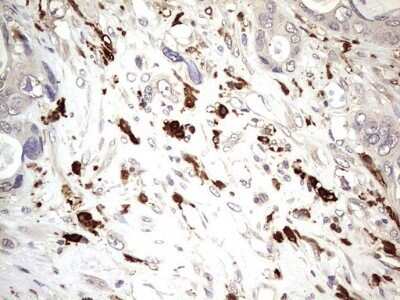 Immunohistochemistry: TRIM27 Antibody (OTI4D4) - Azide and BSA Free [NBP2-74609] - Analysis of Adenocarcinoma of Human colon tissue. (Heat-induced epitope retrieval by 1 mM EDTA in 10mM Tris, pH8.5, 120C for 3min)