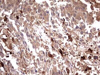 Immunohistochemistry: TRIM27 Antibody (OTI4D4) - Azide and BSA Free [NBP2-74609] - Analysis of Adenocarcinoma of Human ovary tissue. (Heat-induced epitope retrieval by 1 mM EDTA in 10mM Tris, pH8.5, 120C for 3min)