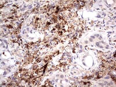 Immunohistochemistry: TRIM27 Antibody (OTI4D4) - Azide and BSA Free [NBP2-74609] - Analysis of Carcinoma of Human lung tissue .(Heat-induced epitope retrieval by 1 mM EDTA in 10mM Tris, pH8.5, 120C for 3min)