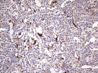 Immunohistochemistry: TRIM27 Antibody (OTI4D4) - Azide and BSA Free [NBP2-74609] - Analysis of Human lymphoma tissue. (Heat-induced epitope retrieval by 1 mM EDTA in 10mM Tris, pH8.5, 120C for 3min)