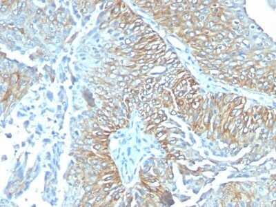Immunohistochemistry-Paraffin: TRIM29 Antibody (TRIM29/1041) - Azide and BSA Free [NBP2-47808] - Human Esophageal carcinoma stained with TRIM29 Monoclonal Antibody (TRIM29/1041).