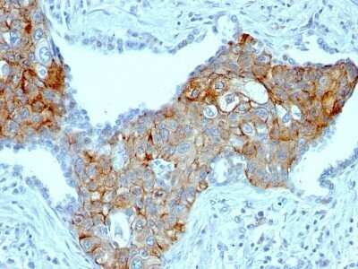 Immunohistochemistry-Paraffin: TRIM29 Antibody (TRIM29/1041) - IHC-Prediluted [NBP2-48093] - Human Lung Squamous Cell Carcinoma stained with TRIM29 Monoclonal Antibody (TRIM29/1041).