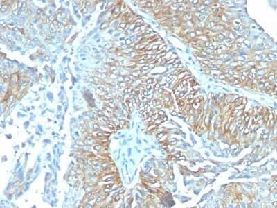 Immunohistochemistry-Paraffin: TRIM29 Antibody (TRIM29/1041) - IHC-Prediluted [NBP2-48093] - Human Esophageal carcinoma stained with TRIM29 Monoclonal Antibody (TRIM29/1041).