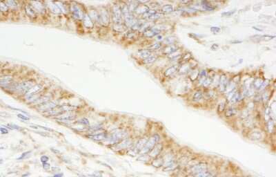 Immunohistochemistry-Paraffin: TRIM3/BERP Antibody [NB100-60400] - Section of human colon carcinoma. Antibody: Affinity purified rabbit anti- TRIM3/BERP used at a dilution of 1:1,000 (1ug/ml). Detection: DAB