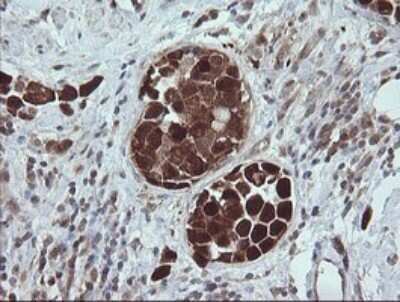 Immunohistochemistry: TRIM44 Antibody (OTI1E10) - Azide and BSA Free [NBP2-74611] - Analysis of Carcinoma of Human bladder tissue.
