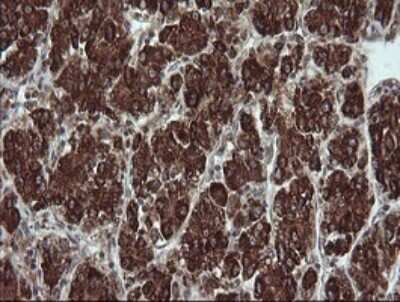 Immunohistochemistry: TRIM44 Antibody (OTI1E10) - Azide and BSA Free [NBP2-74611] - Analysis of Carcinoma of Human liver tissue.