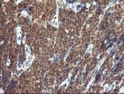 Immunohistochemistry: TRIM44 Antibody (OTI1E10) - Azide and BSA Free [NBP2-74611] - Analysis of Human lymphoma tissue.