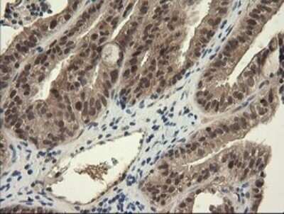 Immunohistochemistry: TRIM45 Antibody (OTI3G3) - Azide and BSA Free [NBP2-74612] - Analysis of Adenocarcinoma of Human ovary tissue. (Heat-induced epitope retrieval by 10mM citric buffer, pH6.0, 120C for 3min)