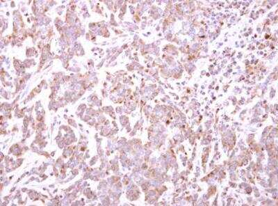 Immunohistochemistry-Paraffin: TRIM49 Antibody [NBP2-20721] -  Paraffin-embedded TOV-21G xenograft. TRIM49 antibody [N1C1] dilution: 1:500.