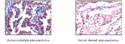 Immunohistochemistry: TRIM5 alpha Antibody (3B11H2) [NB100-2192] - Analysis of human metastatic adenocarcinoma(A) and stomach adenocarcinoma (B), showing cytoplasmic localization using Trim5a mouse mAb with AEC staining (A) and DAB staining(B).