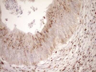 Immunohistochemistry: TRIM56 Antibody (5A1) [NBP2-46232] - Analysis of Adenocarcinoma of Human colon tissue. (Heat-induced epitope retrieval by 1mM EDTA in 10mM Tris buffer (pH8.5) at 120C for 3 min)